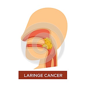 Laringe cancer illness malignant tumor in throat photo