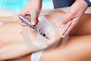 Laser acupuncture