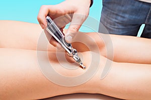 Laser acupuncture