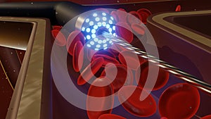 A laser atherectomy device operating within an artery