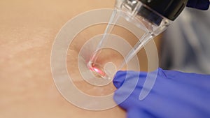 Laser cosmetic surgery and skin resurfacing in dermatology. Beauty laser technician performing skin resurfacing