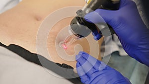 Laser cosmetic surgery and skin resurfacing in dermatology. Having a laser in a skincare clinic, a resurfacing technique