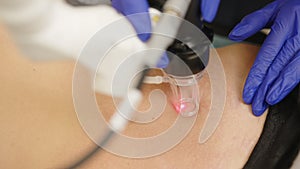 Laser cosmetic surgery and skin resurfacing in dermatology. Having a laser in a skincare clinic, a resurfacing technique