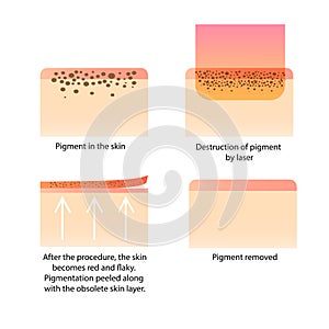 Laserový paprsek kosmetologie. postup odstranění tetování pihy starý tmavý skvrny 