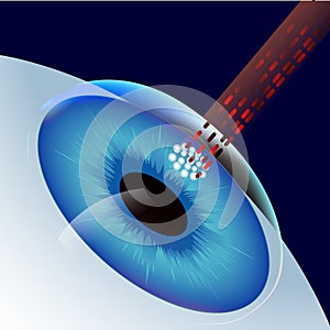 Laser Eye Correction