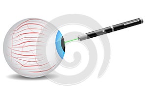 Laser on eye