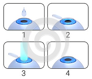 Laser eye surgery procedure. 3D-rendering.