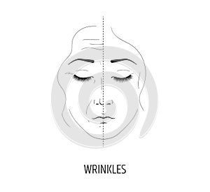 Laser facial rejuvenation. Anti-wrinkle and anti-aging treatment. The effect of the salon procedure. Injection of