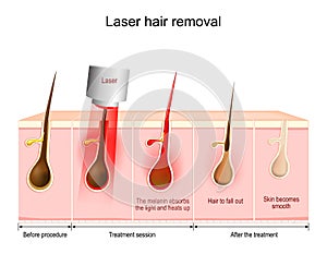 Laser hair removal photo