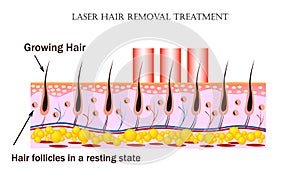 Laser Hair Removal treatment. Procedure causes damage to the hair follicle without hurting the skin tissue and hair