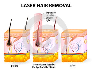 Laser hair removal. Vector diagram photo