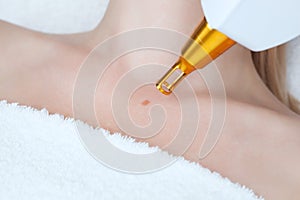 Laser mole removal on a woman`s neck in a beauty salon.