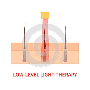 Laser red light therapy treatment of alopecia photo