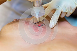 Laserový paprsek odstranění z natáhnout značky na kůže prsa 