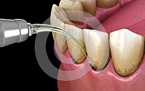Laser removes a thin layer of infected skin, teeth cleaning. Medically accurate tooth 3D illustration