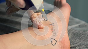 Laser removing of tattoo with words loser, lover and heart on woman's foot.