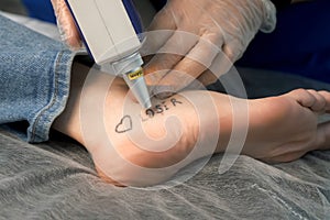 Laser removing of tattoo with words loser, lover and heart on woman& x27;s foot.