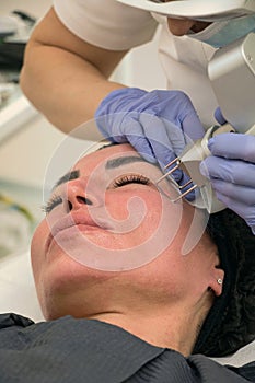 Laser skin rejuvenation, eyelid correction, pigmentation removal, close-up photo