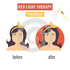 Laser skin rejuvenation. Red light therapy