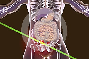 Acute appendicitis illustration