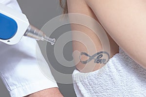 Laser tattoo removal  in clinic closeup photo