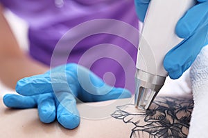 Laser tattoo removal in cosmetic surgery.