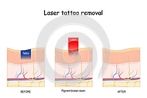 Laser tattoo removal photo