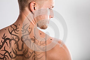 Laser Tattoo Removal On Man`s Back