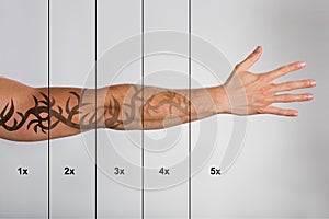 Laserový lúč tetovanie odstránenie na ruka 