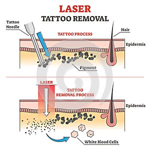 Laser tattoo removal process labeled educational explanation outline concept