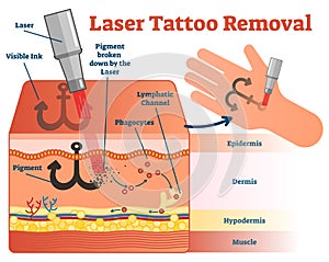 Laser tattoo removal vector illustration diagram. Cosmetic dermatology visual information.