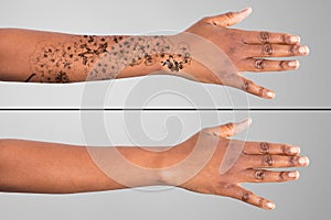 Laser Tattoo Removal On Woman`s Hand