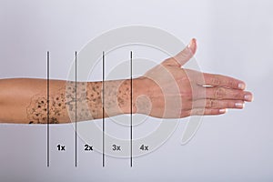 Laser Tattoo Removal On Woman`s Hand photo