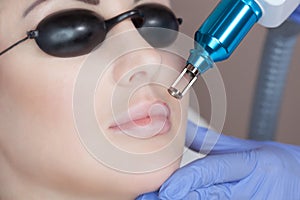 Laser tattoo removal on woman`s on lips