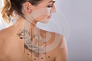 Laser Tattoo Removal On Woman`s Shoulder