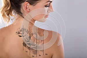 Laser Tattoo Removal On Woman`s Shoulder photo