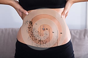 Laser Tattoo Removal On Woman`s Stomach