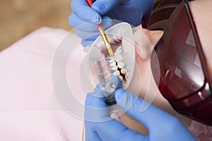 Laser teeth whitening. People, medicine, stomatology and health care concept - close up of female dentist with dental