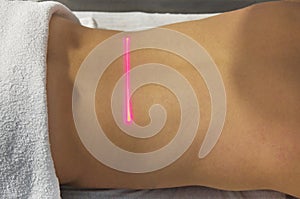 Laser Therapy