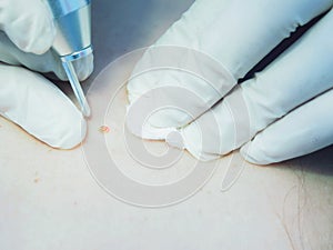 Laser treatment. Close-up portrait of procedure skin nevus removal