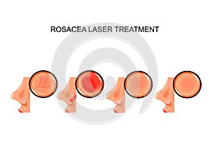 Laser treatment of rosacea