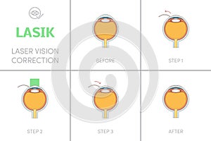 Laser vision correction