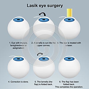 Lasik eye surgery medical vector illustration isolated on white background eps 10 infographic photo
