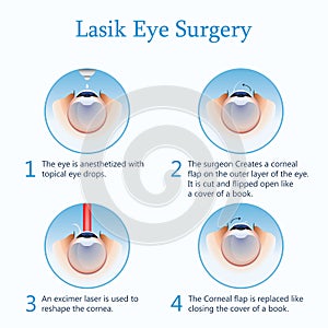 Lasik eye surgery. Vector Illustration