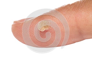 Last stage of verruca