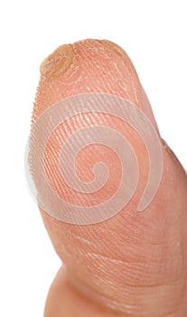 Last stage of verruca