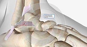 Lateral Ankle Sprain Torn Anterior Talofibular Ligament