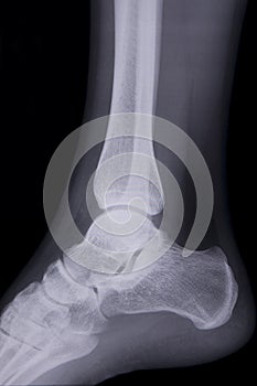 Lateral ankle x-ray