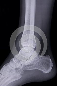Lateral ankle x-ray photo