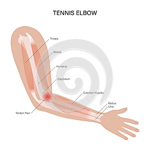 Lateral epicondylitis tennis elbow